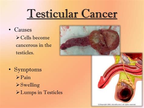 types of testicular lumps